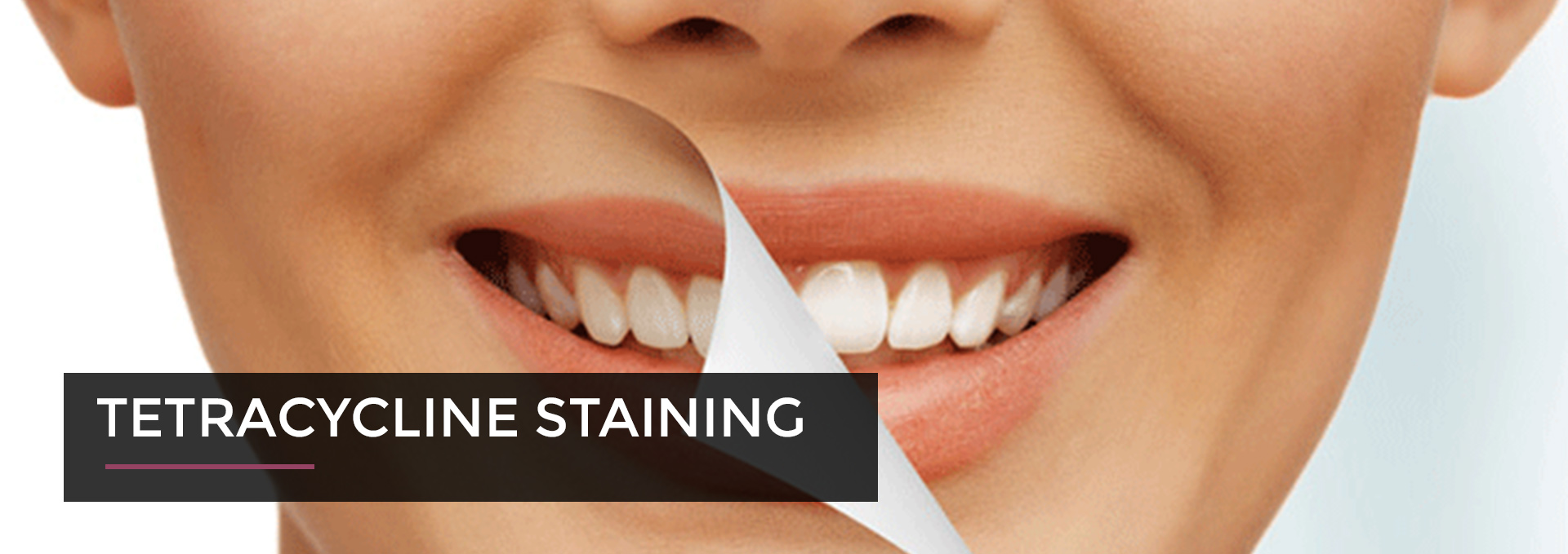 tetracycline-staining-mehan-dental-cambridge-family-practice