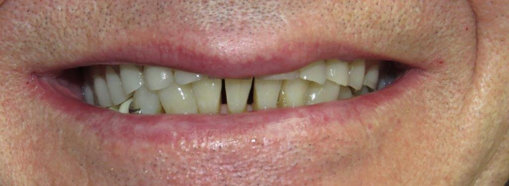 Before Dentures