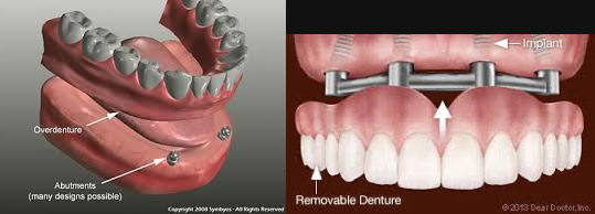 Dental Implants